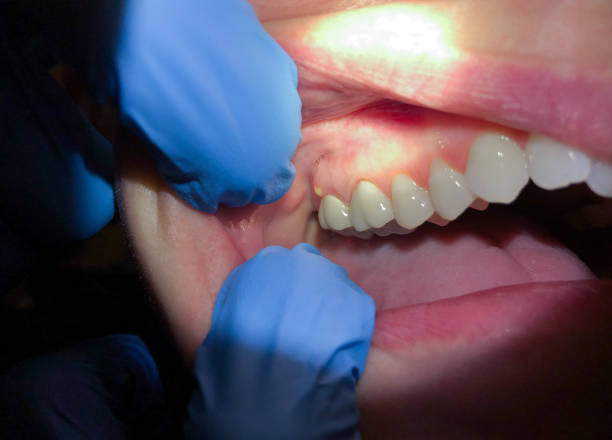Best Dental Abscess Treatment in Swoyersville, PA